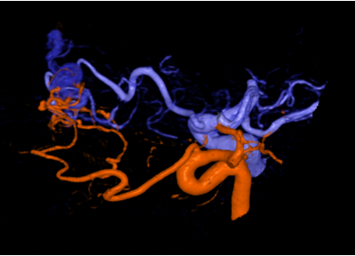 Angiography Imaging